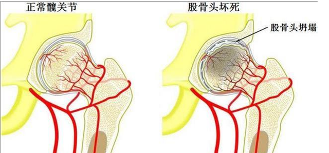 慎用激素藥！激素導(dǎo)致股骨頭壞死不要怕，通血生骨方純中藥調(diào)理，從根源治療！