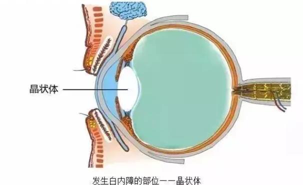 白內(nèi)障術后多久恢復 白內(nèi)障手術后多久可以功能