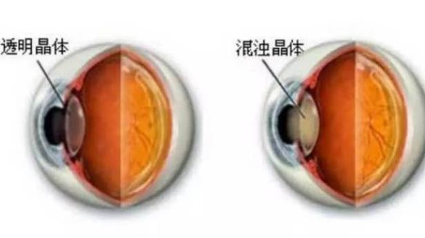 白內(nèi)障后期會(huì)失明嗎 外傷白內(nèi)障會(huì)失明嗎