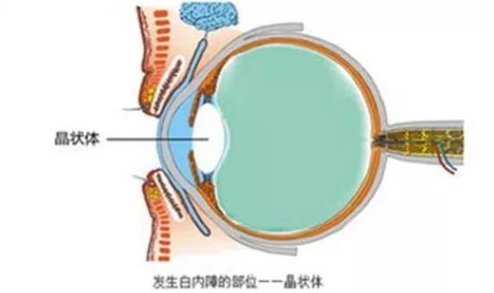 白內(nèi)障術(shù)后眼壓高怎么辦 白內(nèi)障術(shù)后眼壓高多久恢復(fù)