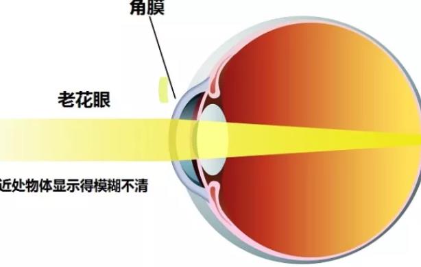 白內(nèi)障只能做超聲乳化手術嗎 白內(nèi)障超聲乳化手術多久恢復