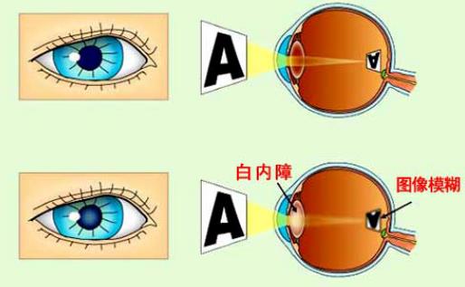 白內(nèi)障嚴重了會怎么樣 眩光色覺屈光改變眼睛敏感度視力下降