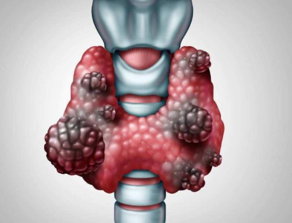 甲狀腺癌怎么辦 甲狀腺癌轉(zhuǎn)移淋巴能治愈嗎