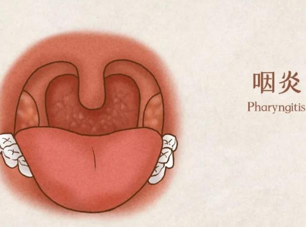 慢性咽炎吃咽炎片有效嗎 咽炎片可以長期吃嗎