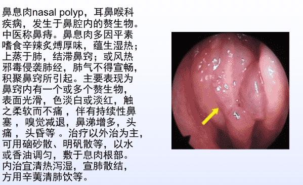 鼻息肉做手術(shù)要住院?jiǎn)?鼻息肉做手術(shù)要住院多久