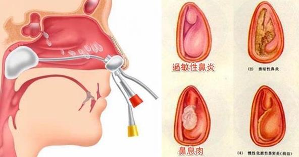 鼻息肉怎么診斷 鼻息肉怎么按摩