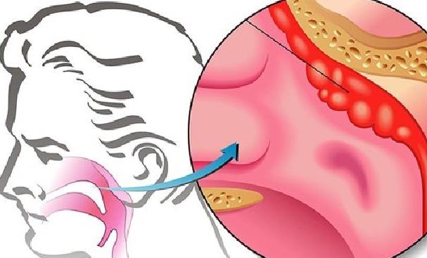 鼻息肉做手術多少錢 鼻息肉可以多久做手術