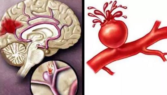 腦梗病人能治愈嗎 腦梗的前期癥狀有哪些