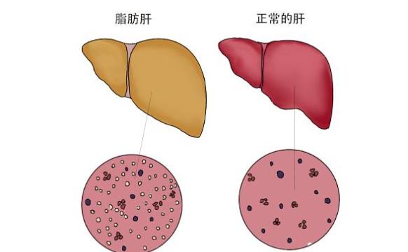 瘦人也會(huì)得脂肪肝嗎 脂肪肝的病因是什么