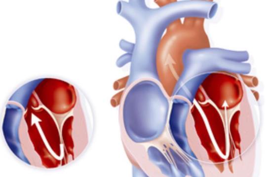 心臟瓣膜病怎么治療 心臟瓣膜病如何護理