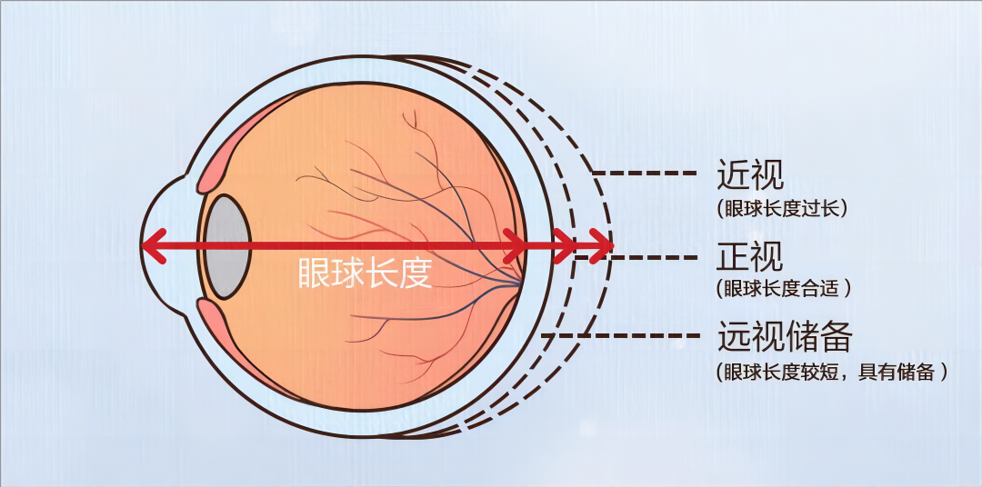 合肥愛爾眼科陳國府醫(yī)生深度揭秘：近視可逆嗎？