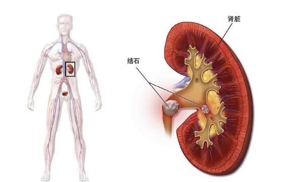 腎結(jié)石怎么辦 腎結(jié)石疼怎么辦