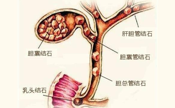 膽結(jié)石患者能吃雞肉嗎 膽結(jié)石術(shù)后能吃雞肉嗎