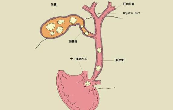 膽結(jié)石10mm怎么辦 膽結(jié)石10mm要開(kāi)刀嗎