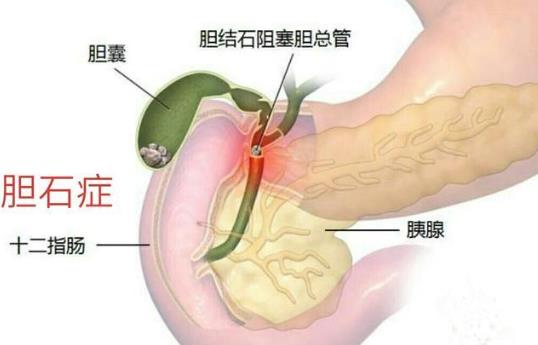 做膽結(jié)石手術(shù)多久能恢復(fù) 膽結(jié)石宜吃什么