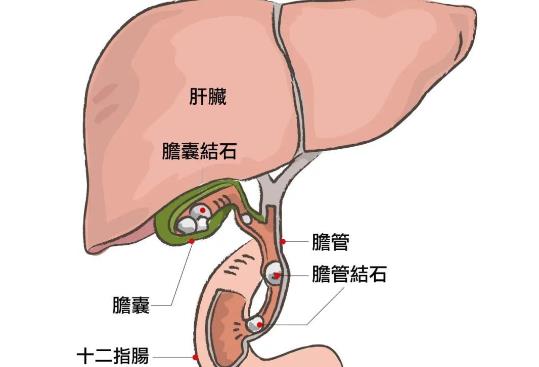 膽結(jié)石拿掉膽會(huì)怎么樣 哪些膽結(jié)石不需要手術(shù)