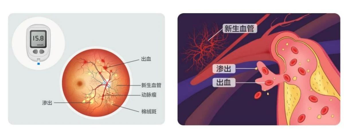 【合肥愛爾】得了糖尿病，為什么醫(yī)生讓我看眼科？