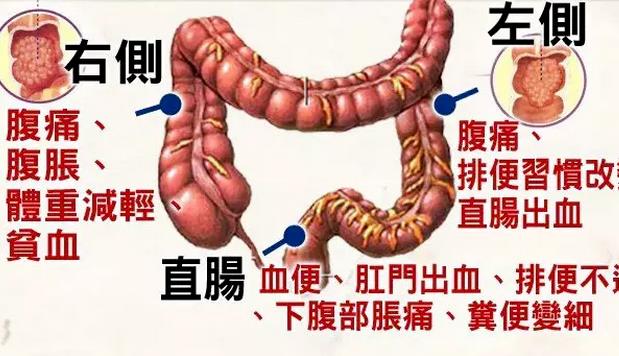 直腸癌能治好嗎 直腸癌中晚期能治好嗎