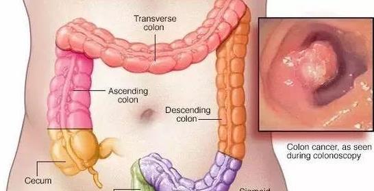 直腸癌會噴血嗎 直腸癌噴血怎么辦