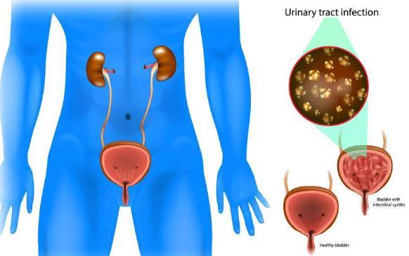 慢性膀胱炎無藥可治嗎 慢性膀胱炎注意什么