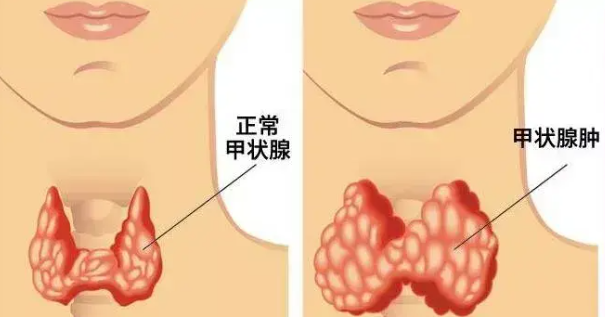 甲狀腺疾病有哪些 甲狀腺疾病怎么回事