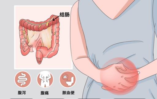 慢性結(jié)腸炎的病因是什么 精神不好感染免疫疾病