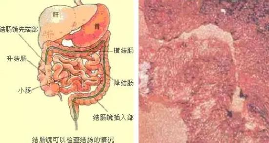 結(jié)腸炎能自愈嗎 結(jié)腸炎怎么調(diào)理