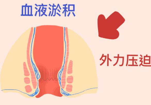 痔瘡用什么藥治療 痔瘡出血用什么藥