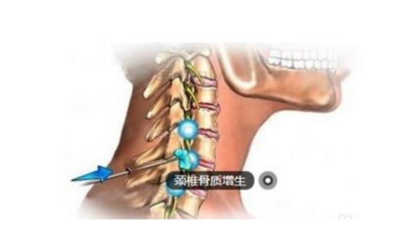 頸椎骨質增生怎么消掉 頸椎病早期注意什么